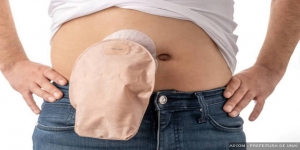Unaí oferta mais bolsas de colostomia e urostomia para pacientes ostomizados